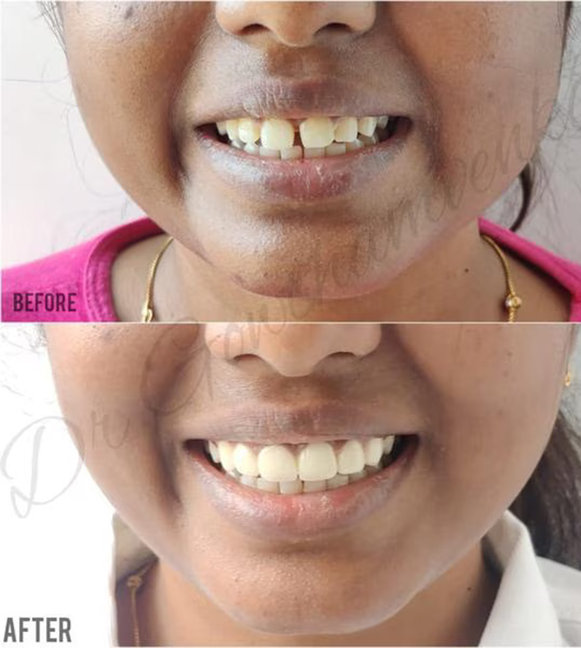 Root Canal Treatment in Vadapalani, Chennai