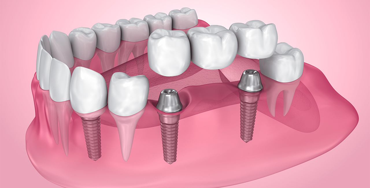 Dentures in Vadapalani
